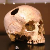 Trepanning: skull with hole